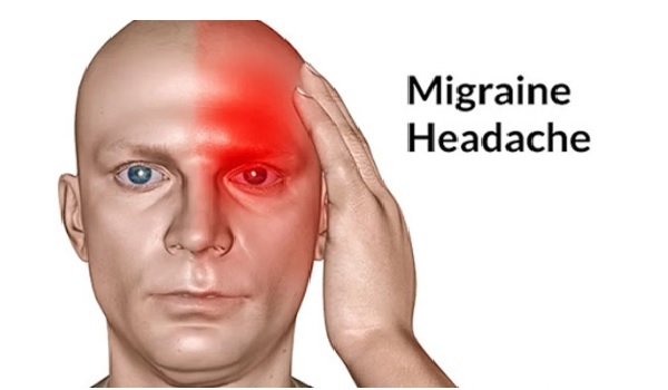 How can migraines be treated