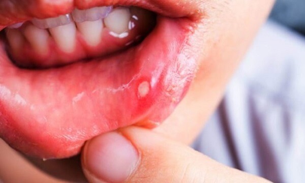 What are the Causes and Treatment of Blisters/Ulcers in the Mouth?