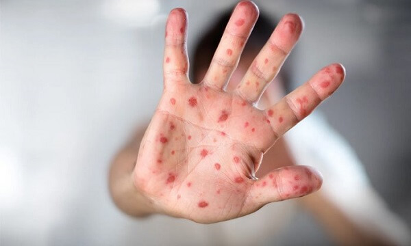 What is Measles Symptoms, Causes, and Treatment?