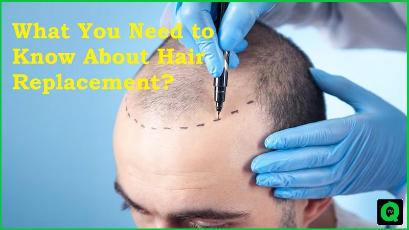 What You Need to Know About Hair Replacement?