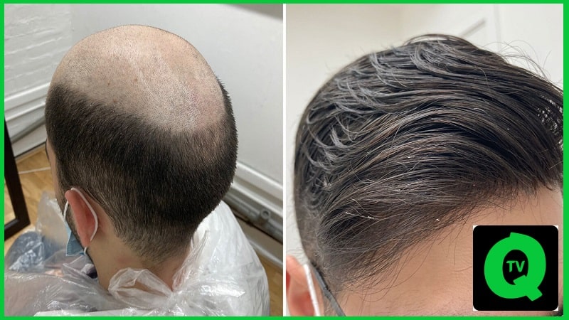Transforming Lives with High-Quality Hair Replacement Solutions